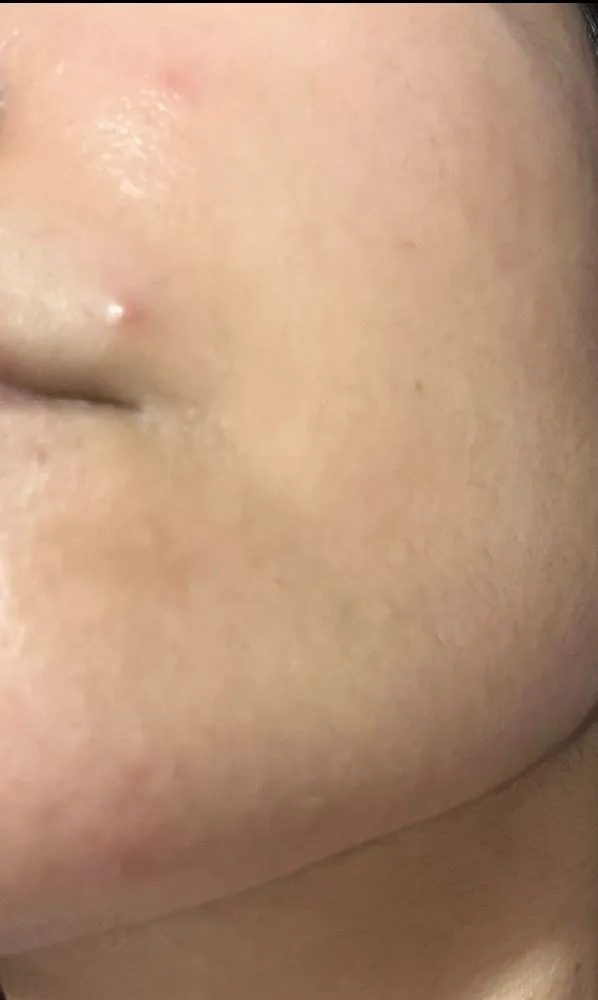 Painful acne and texture on my chin what I’m dealing with