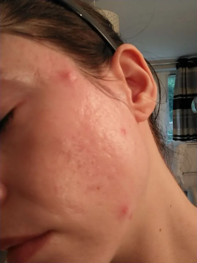 24 years of Acne
