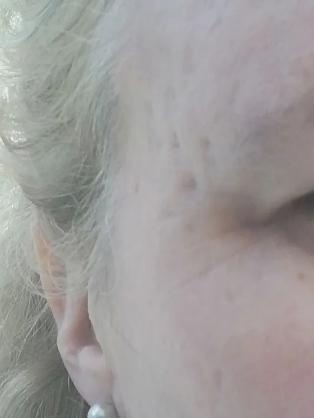 Acne scars on temple